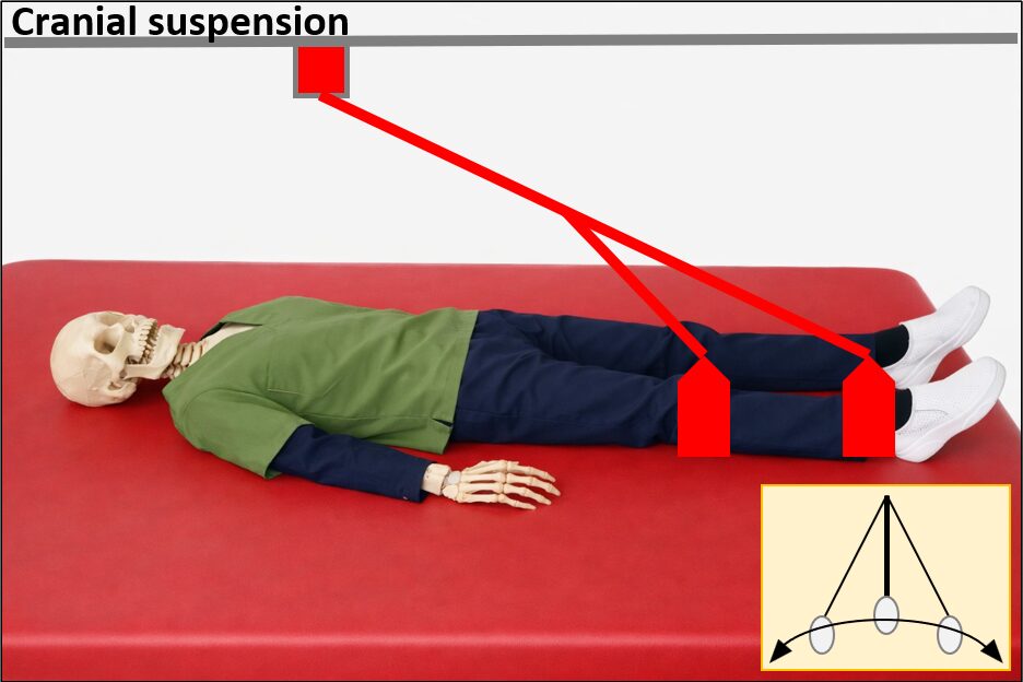 Cranial suspensionの画像