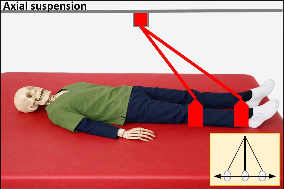 Axial suspensionの図解