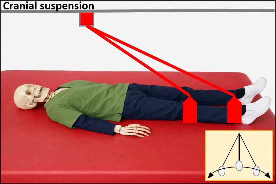 Cranial suspensionの画像