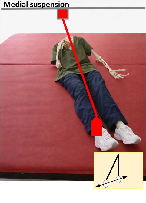 Medial suspensionの図解